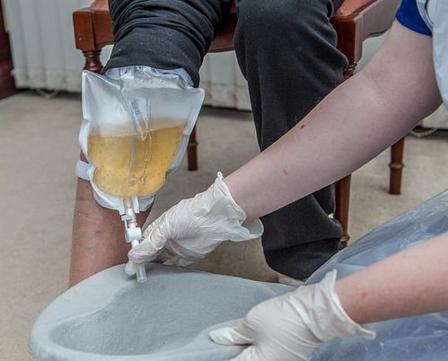 導(dǎo)尿,截癱,注意事項(xiàng),自我