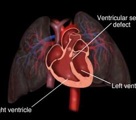 心室間隔缺損小孩兒術(shù)前注意事項