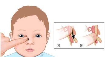 寶寶做淚道手術(shù)的注意事項(xiàng)