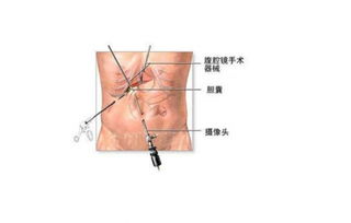 肺葉,切除,手術(shù)后,注意事項
