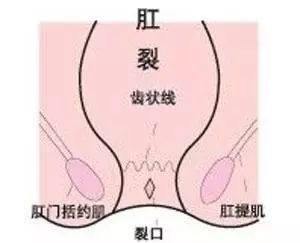 好了,注意事項(xiàng),飲食,肛裂