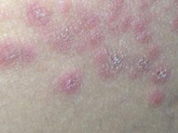 體癬,應(yīng)注意,事項(xiàng)