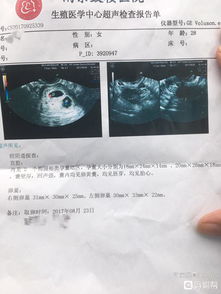 移植雙胎得注意事項(xiàng)