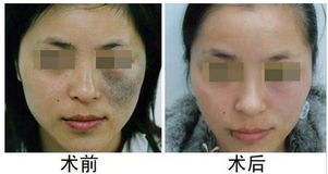 上海第九人太田痣激光后注意事項