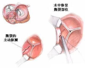 換生物瓣膜后注意事項(xiàng)