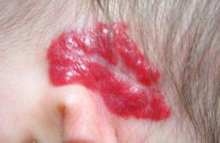 腦血管瘤的注意事項,腦血管瘤術(shù)后注意事項,腦血管瘤飲食注意事項