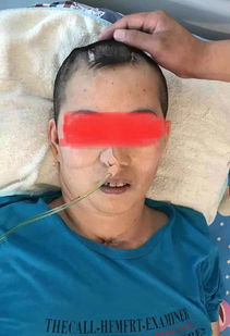 昏迷患者鼻飼注意事項