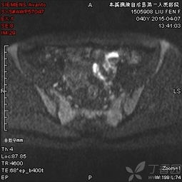 注意事項(xiàng),增強(qiáng),檢查,mri