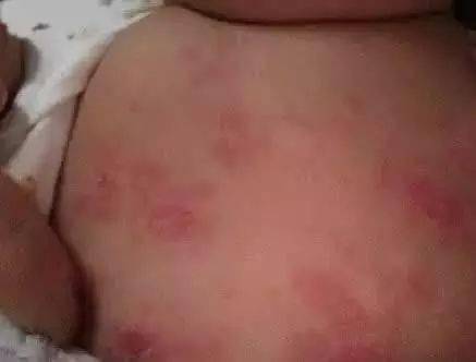 寶寶起疹子注意事項(xiàng)
