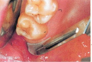 拔第一磨牙后注意事項