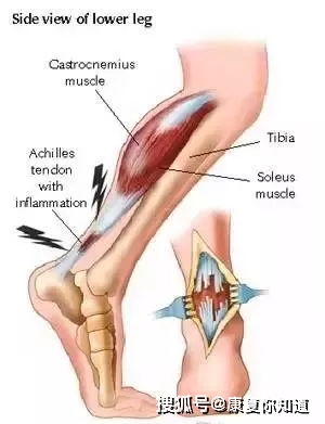 跟腱,斷裂,注意事項(xiàng),手術(shù)