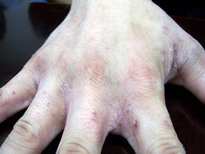 疥瘡的治療及注意事項,得了疥瘡的注意事項,疥瘡用藥的注意事項