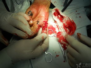 攣縮,瘢痕,注意事項