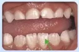 撥下門牙的注意事項(xiàng),種植門牙注意事項(xiàng),補(bǔ)完門牙注意事項(xiàng)
