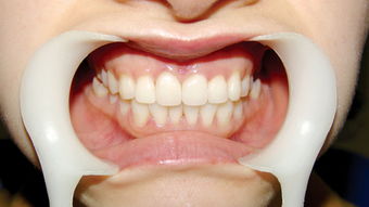 門(mén)牙,注意事項(xiàng)