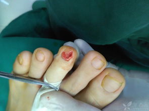 甲下骨疣是的注意事項