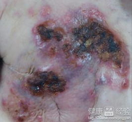 乳腺癌,二期,手術(shù)后,注意事項(xiàng)