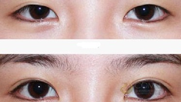 雙眼皮,注意事項(xiàng)