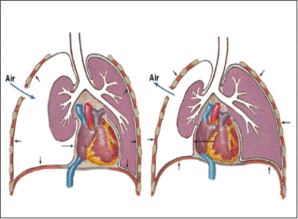 氣胸,注意事項,負壓,吸引