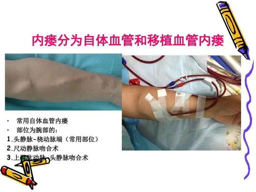 動(dòng)靜脈瘺護(hù)理注意事項(xiàng)