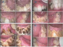 口腔放射注意事項