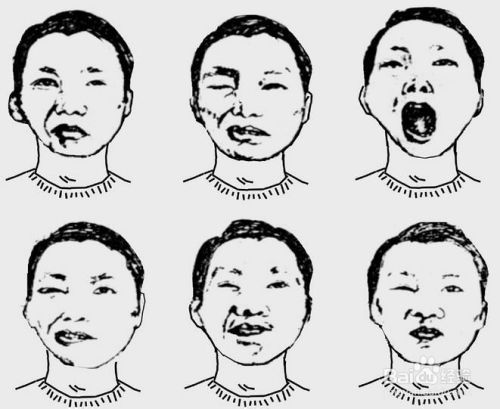 面癱,治愈,注意事項