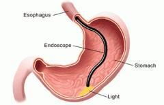 做無(wú)痛胃鏡需要注意什么事項(xiàng),無(wú)痛胃鏡要注意什么,做完無(wú)痛胃鏡和腸鏡后要注意事項(xiàng)
