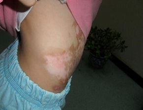 外傷,注意事項(xiàng),生活