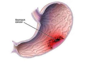 胃部,出血,注意事項(xiàng)