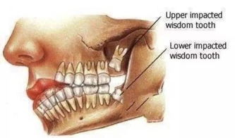 智齒切肉后注意事項(xiàng),拔智齒注意事項(xiàng)與禁忌,女性拔智齒注意事項(xiàng)