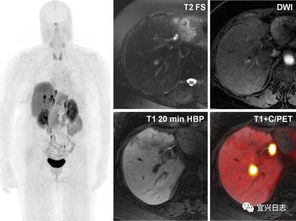 做完petct之后注意事項,做完petct注意事項,做petct注意事項