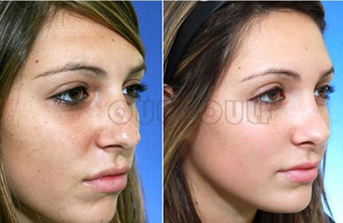 冰點(diǎn)波拉皮注意事項(xiàng)