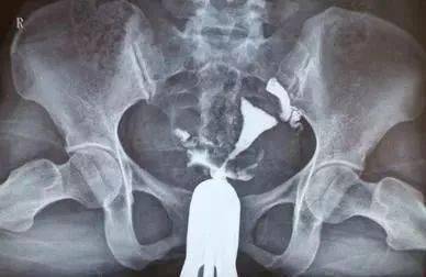 輸暖管造影后注意事項