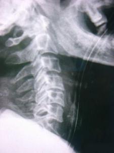 頸椎,骨折,翻身,注意事項(xiàng)