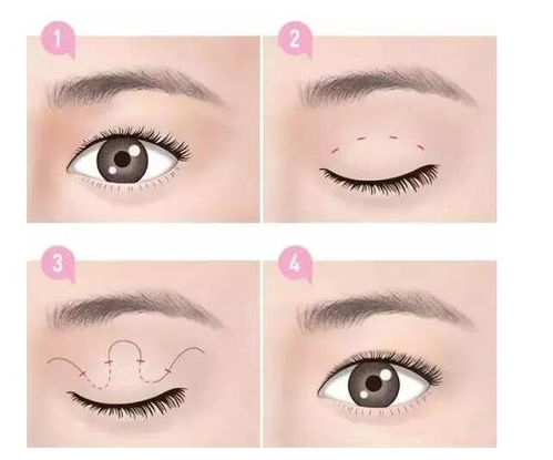 割雙眼皮注意事項(xiàng)?,做完雙眼皮睡覺注意事項(xiàng),割雙眼皮前期注意事項(xiàng)