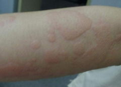 小兒急性蕁麻疹注意事項