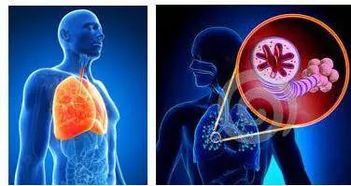 慢性阻塞型肺氣腫用氧注意事項(xiàng)