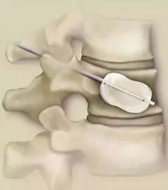 腰椎,注意事項(xiàng),壓縮,飲食