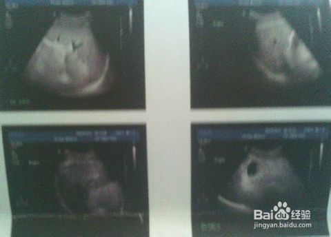 懷孕照b超注意事項(xiàng)