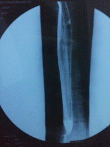 上消化道鋇餐造影注意事項,鋇餐造影做完后注意事項,鋇餐灌腸造影注意事項