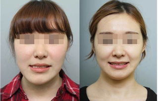 面部不對(duì)稱整形注意事項(xiàng)