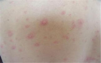 梅毒患者注意事項飲食