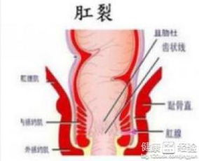 流血,注意事項,肛裂