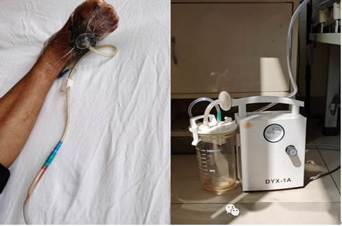 注意事項,負壓,吸引,vsd