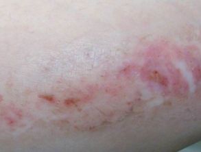 注意事項,扁平苔蘚