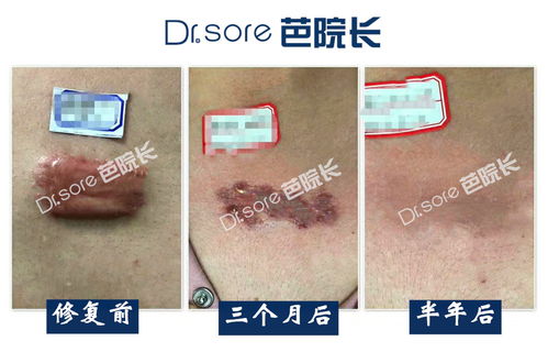 疤痕切除術(shù)后注意事項(xiàng)