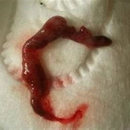 打胎后注意事項(xiàng)藥流