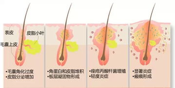 痤瘡性皮膚注意事項