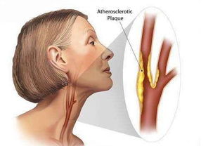 生活上,注意事項(xiàng),有頸斑塊
