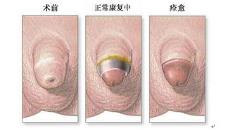 包皮,大連,注意事項(xiàng),手術(shù)